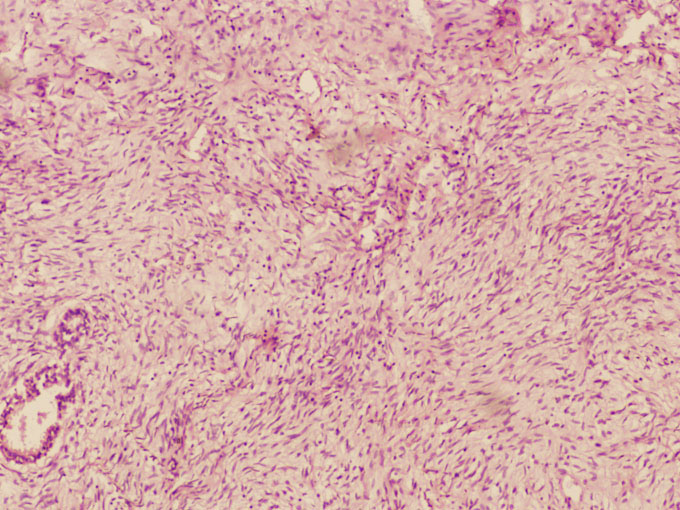 Figure 2: photomicrograph showing phyllodes tumor
